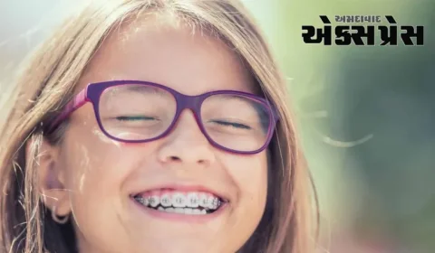 શું દાંતને તાર લગાવવાથી ચહેરાનો દેખાવ બદલાઈ જાય છે?