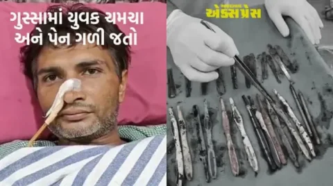 નશા મુક્તિ કેન્દ્રના દર્દીના પેટમાંથી નીકળ્યા 29 ચમચા અને 19 ટૂથબ્રશ!
